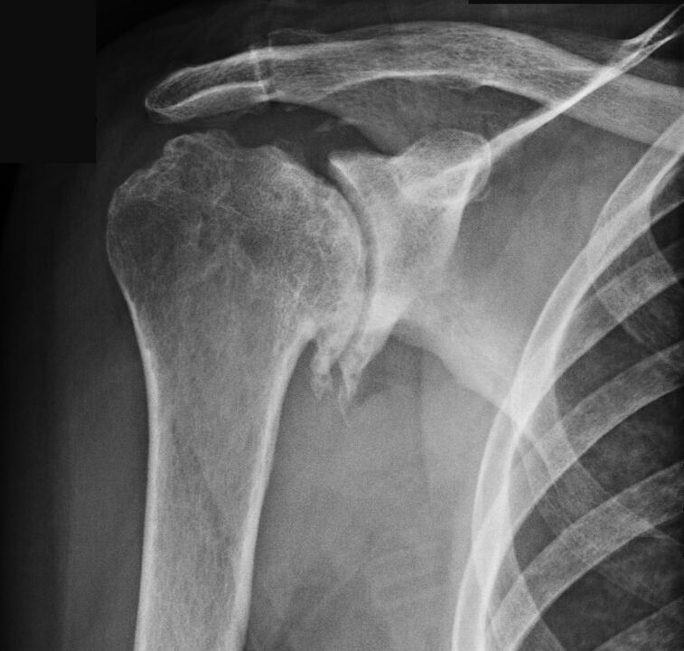 The X-ray showed arthrosis of the shoulder