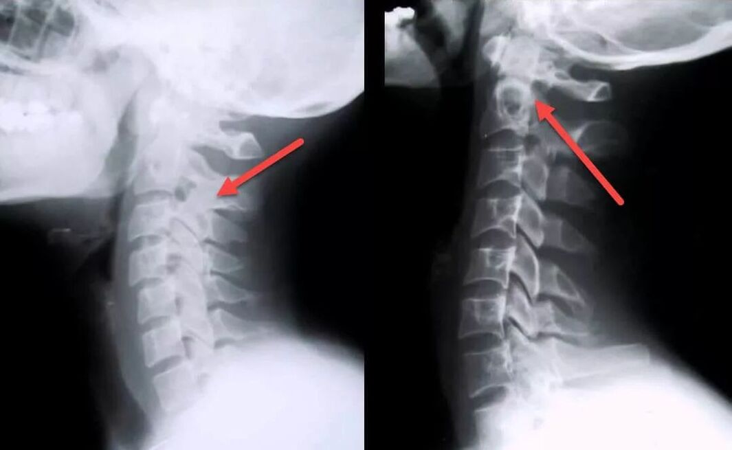 Diagnosis of cervical osteochondrosis