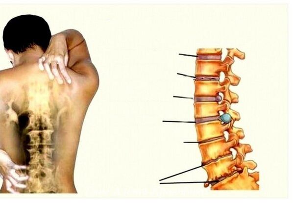 Stadiums of cervical osteochondrosis