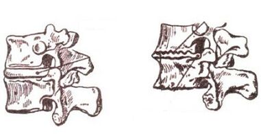 Development stages of the cervix osteochondrosis