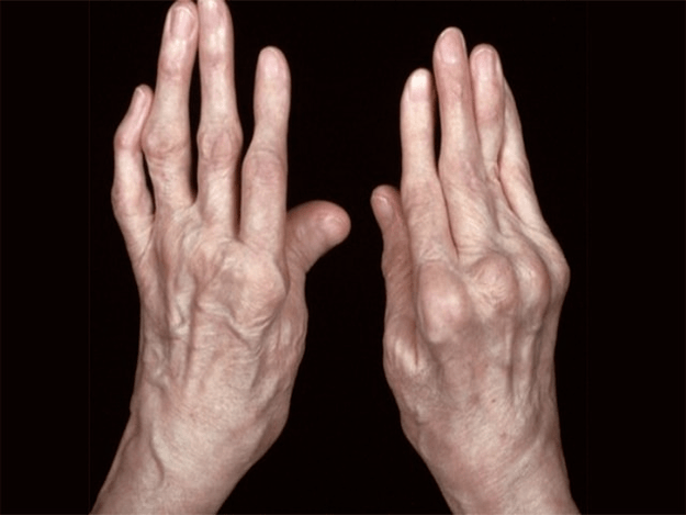 Arthritis as the cause of pain in the fingers joints