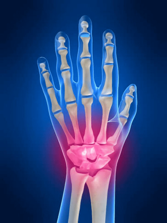 Arthritis of the wrist joint