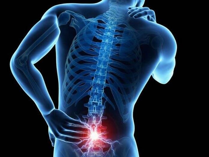 With radiculitis, pinched nerve roots cause the appearance of sharp pain in the lower back