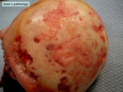 Cartilage surface affected by osteoarthritis