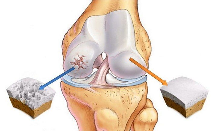 Healthy and arthritic joints