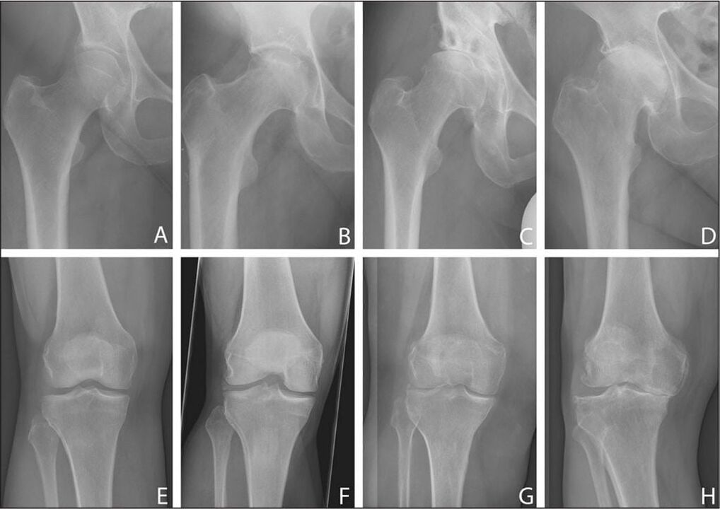 Stages of development of joint arthrosis in the x-ray image
